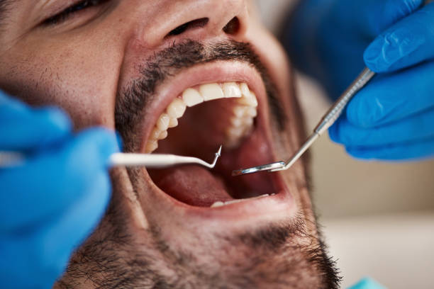 Best Chipped Tooth Repair Near Me  in San Mateo, CA